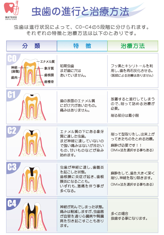 虫歯の分類と治療