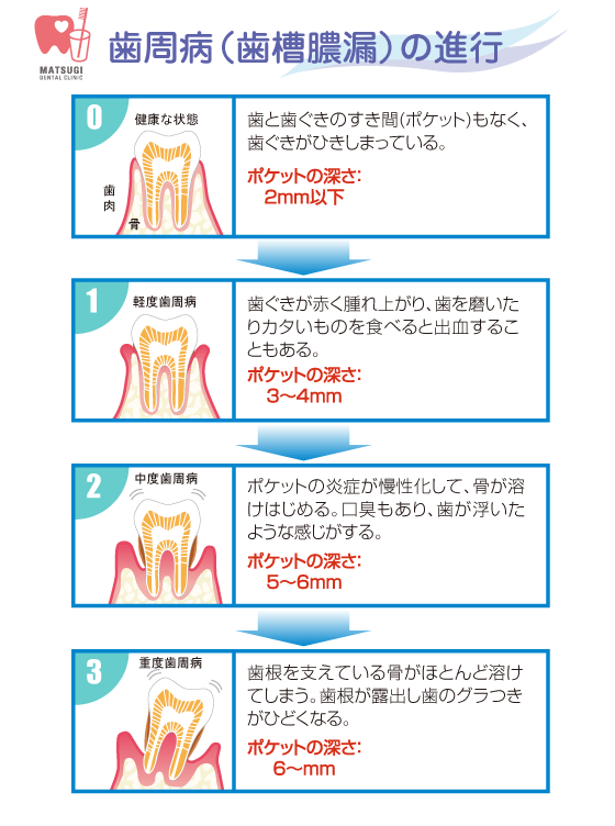 歯槽膿漏の進行