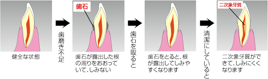 歯石を取ると歯がしみるわけ