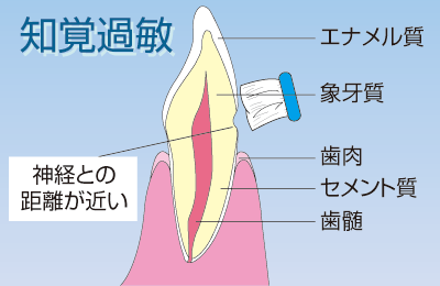 知覚過敏