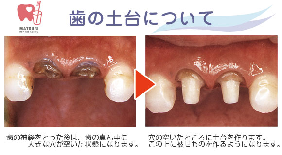 し 歯 みる 水