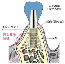 インプラント図解