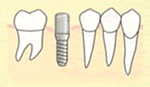 インプラント治療の流れ04