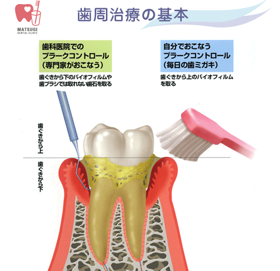 病 歯 治し 方 周