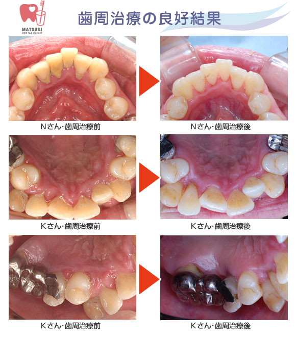 歯周治療の良好結果