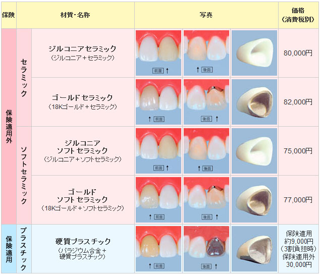前歯のかぶせ物（前歯のクラウン）の価格