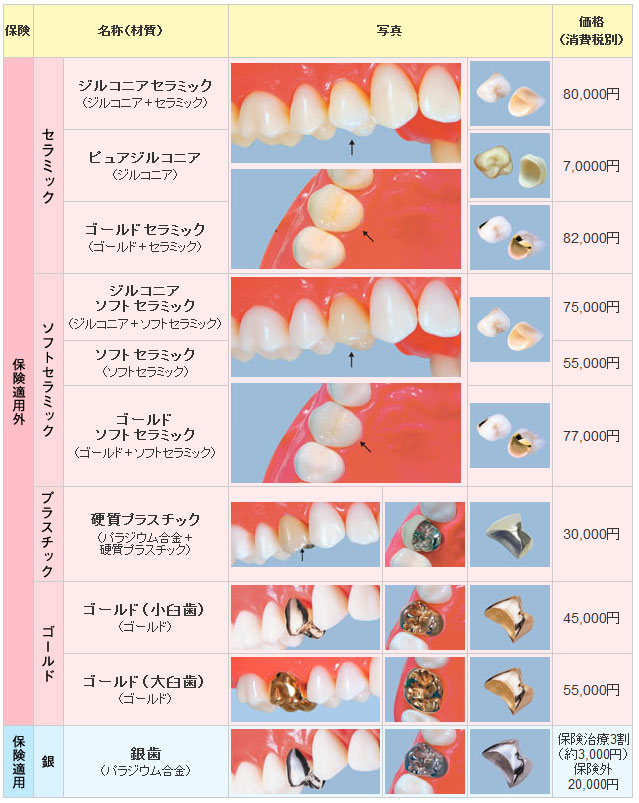 臼歯のかぶせ物（臼歯のクラウン）の価格