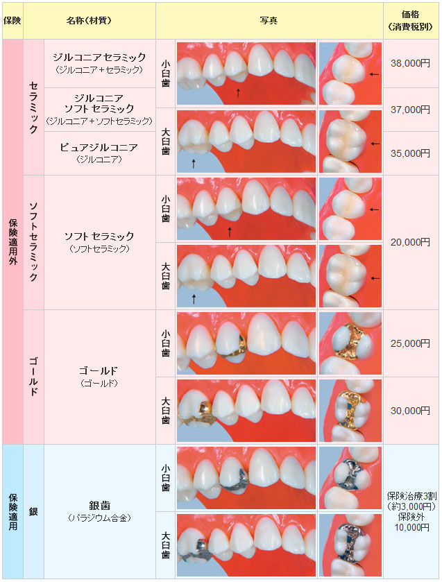 臼歯のつめ物（臼歯のインレー）の価格