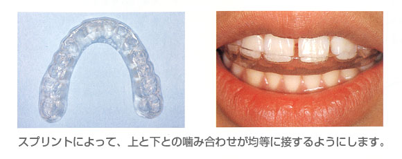 スプリントでの治療