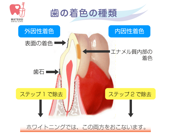 歯の着色の種類