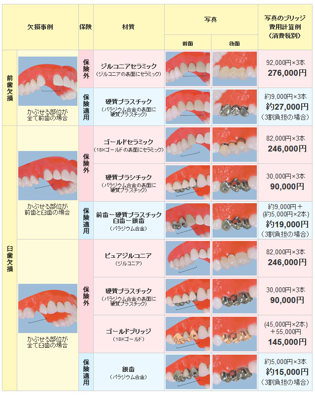 前歯＆臼歯のかぶせ物（前歯＆臼歯のブリッジ）の価格