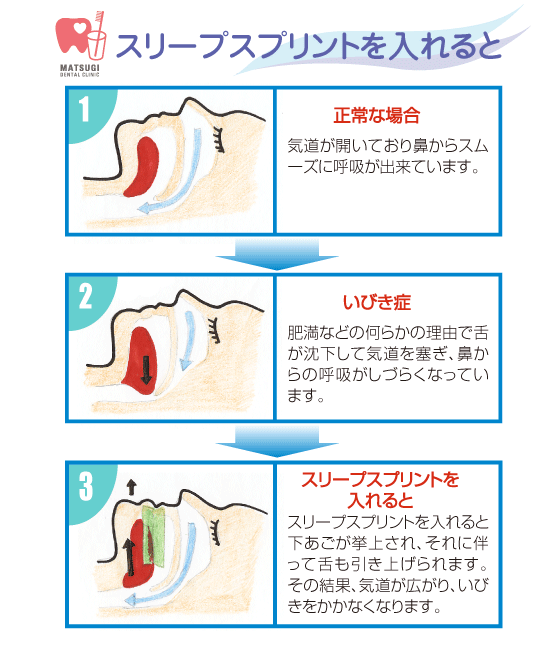 スリープスプリントを入れると