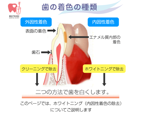 歯の着色の種類